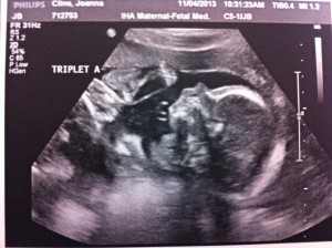 TripletA_22wks