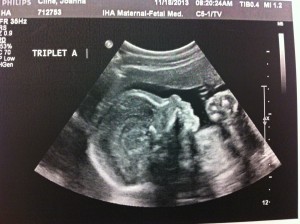 TripletA_24wks