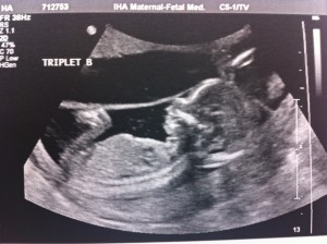 TripletB_16wks