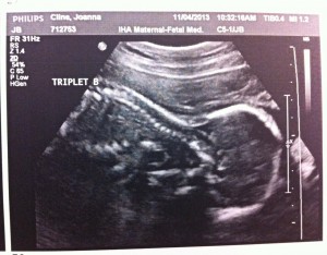 TripletB_22wks
